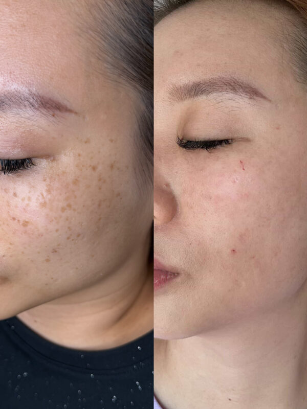 Age Spots & Solar Lentigines